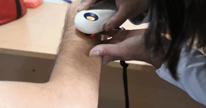 Controles gratuitos de lunares en el barrio Sanidad para prevenir el cáncer de piel