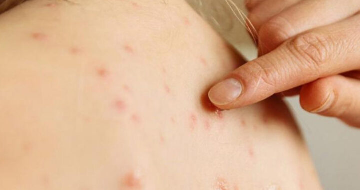 Salta refuerza la vigilancia epidemiológica tras la alerta nacional por sarampión